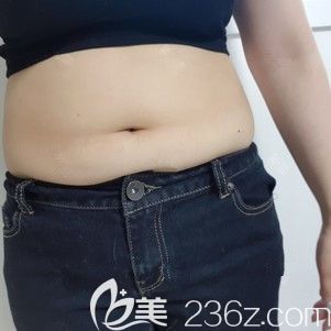在韓國愛我IWELL整形醫(yī)院三重腹部吸脂術(shù)后不到半年就告別了“水桶腰”