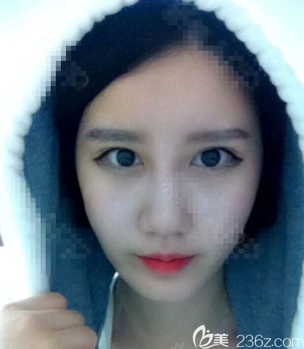 在韓國綺林整形做了隆鼻墊鼻基底埋線雙眼皮加提肌矯正路人甲從此有了更多追求者