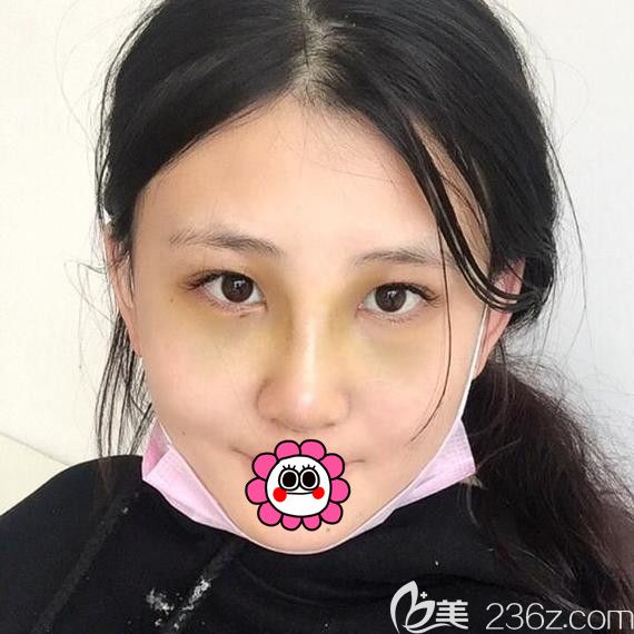 耳軟骨隆鼻術(shù)后五天效果