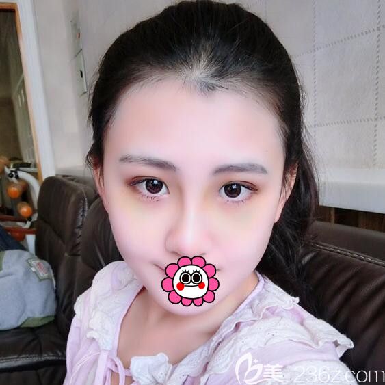 耳軟骨隆鼻術(shù)后半個(gè)月