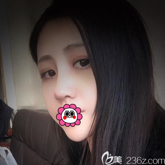 陳富全耳軟骨隆鼻術(shù)后恢復(fù)效果