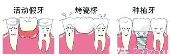 活動假牙、烤瓷橋、種植牙的區(qū)別