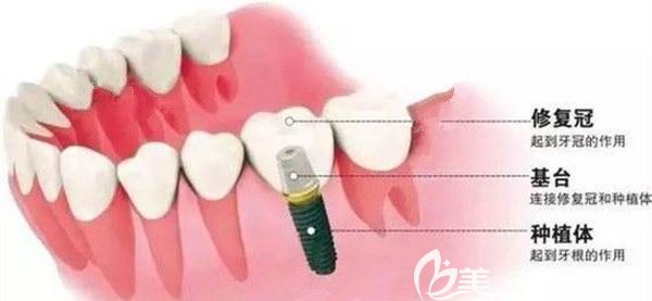 種植牙的流程圖