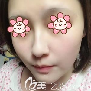 幫我鑒定鑒定花了兩千大洋在武漢壹加壹做的激光祛斑效果怎么樣，值不值這個價錢