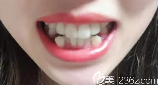 我在南京博韻口腔做牙齒矯正戴牙套前的照片 我在南京博韻口腔做牙齒矯正戴牙套前的照片