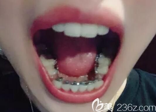 我在南京博韻口腔做舌側(cè)矯正第3個(gè)月 我在南京博韻口腔做舌側(cè)矯正第3個(gè)月