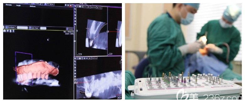 廣州廣大口腔精準(zhǔn)"即刻用"種植牙技術(shù)優(yōu)勢 廣州廣大口腔精準(zhǔn)"即刻用"種植牙技術(shù)優(yōu)勢