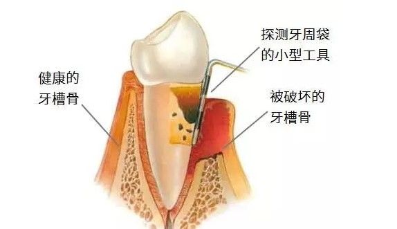 牙槽骨萎縮示意圖 牙槽骨萎縮示意圖