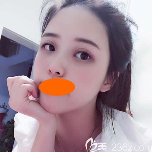 贛州華美整形路衛(wèi)國(guó)院長(zhǎng)給我割雙眼皮+隆鼻術(shù)后5天 贛州華美整形路衛(wèi)國(guó)院長(zhǎng)給我割雙眼皮+隆鼻術(shù)后5天