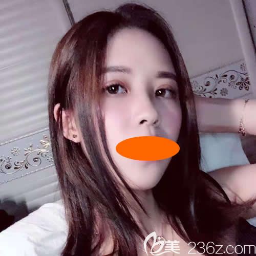 贛州華美整形路衛(wèi)國(guó)院長(zhǎng)給我割雙眼皮+隆鼻術(shù)后第26天 贛州華美整形路衛(wèi)國(guó)院長(zhǎng)給我割雙眼皮+隆鼻術(shù)后第26天