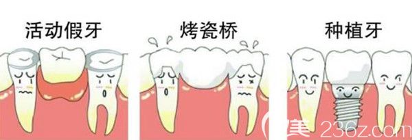 活動(dòng)假牙、烤瓷橋、種植牙的區(qū)別