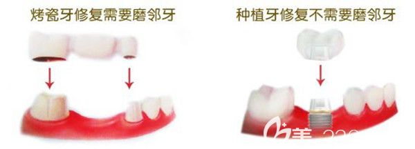 烤瓷牙修復(fù)與種植牙修復(fù)的優(yōu)缺點(diǎn)