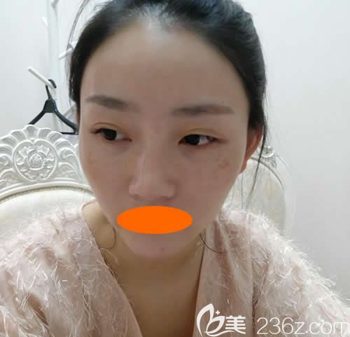 我去贛州華美醫(yī)療美容做自體脂肪填充全臉前照片 我去贛州華美醫(yī)療美容做自體脂肪填充全臉前照片