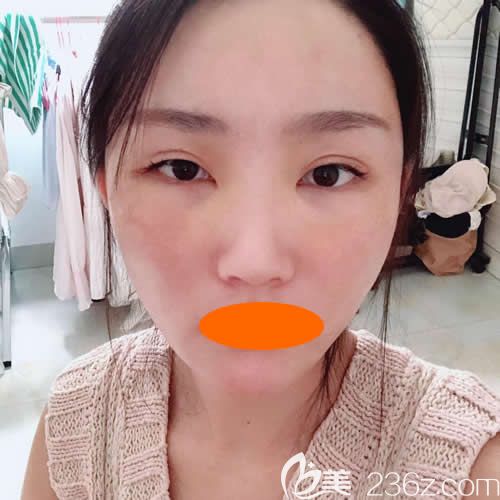 找贛州華美整形路衛(wèi)國做了自體脂肪填充全臉術(shù)后5天 找贛州華美整形路衛(wèi)國做了自體脂肪填充全臉術(shù)后5天