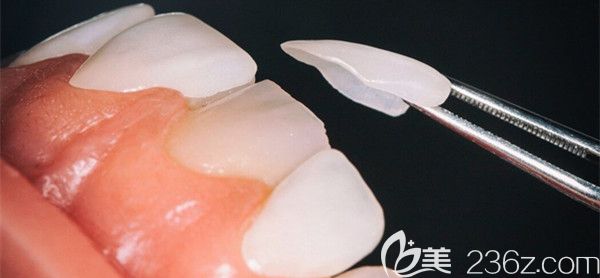 超薄瓷貼面的優(yōu)勢 超薄瓷貼面的優(yōu)勢