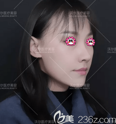 聽聞劉彥軍全肋隆鼻做的還行我就在北京沃爾做了肋軟骨隆鼻附價(jià)格