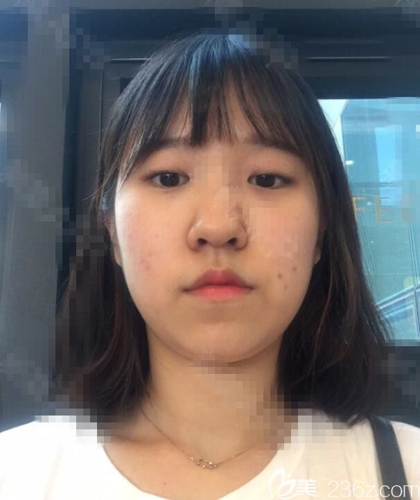 術(shù)前 術(shù)前