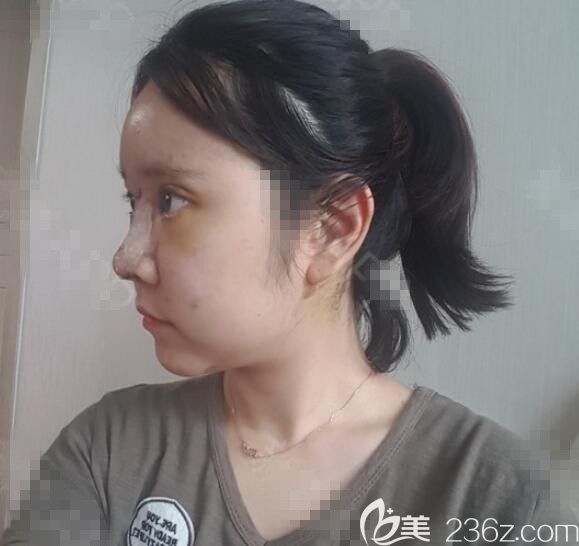 剛做完手術(shù) 剛做完手術(shù)