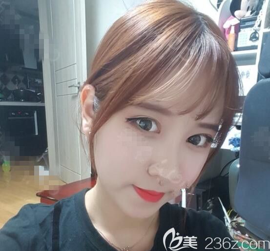 平凡的我在韓國(guó)德麗珍整形做了眼睛鼻子脂肪移植面部吸脂后收獲了一張高級(jí)臉