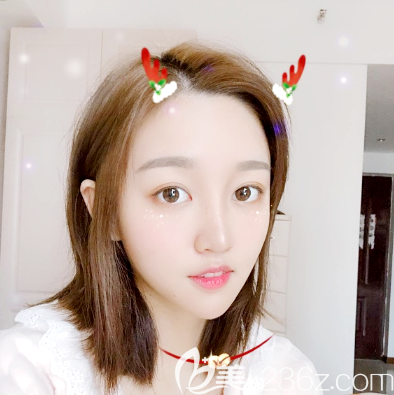 廣州海峽李希軍做的鼻綜合隆鼻一個月<span style=