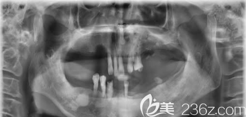 種牙前的CT片 種牙前的CT片