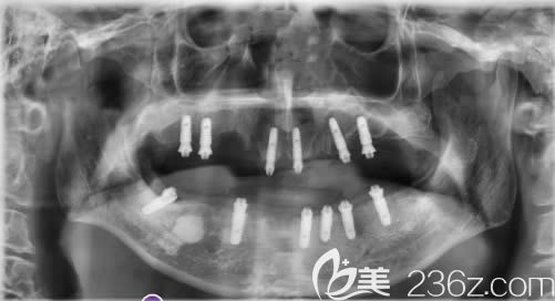 植入口內(nèi)的12顆韓國奧齒泰種植體 植入口內(nèi)的12顆韓國奧齒泰種植體