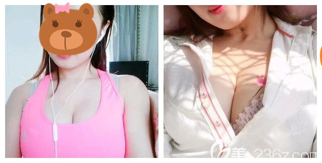 相比國產(chǎn)威寧我選擇價格略貴的美國進(jìn)口曼托假體 再加上常州美貝爾內(nèi)窺鏡+雙平面技術(shù)術(shù)后胸部自然無異物感