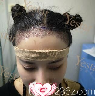 種植發(fā)際線術(shù)后即刻<span style=