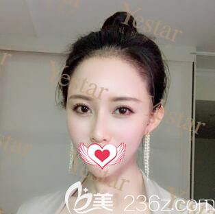 種植發(fā)際線術(shù)后半個(gè)月<span style=