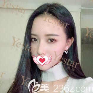 在長(zhǎng)沙做發(fā)際線種植37天<span style=