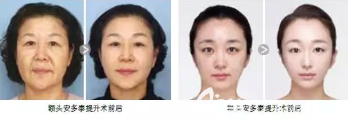 韓國巴諾巴奇醫(yī)院安多泰額頭提升術(shù)前術(shù)后效果對比圖