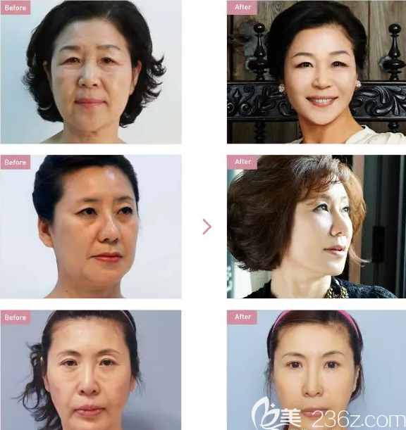 韓國巴諾巴奇醫(yī)院面部年輕化案例效果對比圖