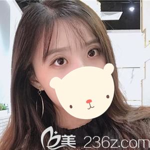 朱醫(yī)生做眼部綜合整形術(shù)后56天雙眼皮和眼角恢復(fù)自然 朱醫(yī)生做眼部綜合整形術(shù)后56天雙眼皮和眼角恢復(fù)自然