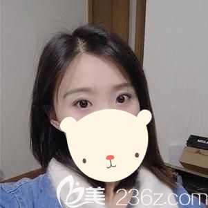 做眼綜合整形術(shù)后12天眼部腫脹消除眼角疤痕漸消 做眼綜合整形術(shù)后12天眼部腫脹消除眼角疤痕漸消