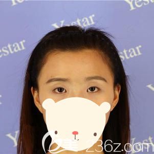 到武漢藝星做眼部綜合整形術(shù)前眼部無神的自己 到武漢藝星做眼部綜合整形術(shù)前眼部無神的自己