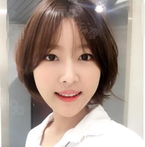 韓國(guó)美迪瑩徐范信：無金屬顴骨縮小術(shù)下頜角下巴后，少女感自帶