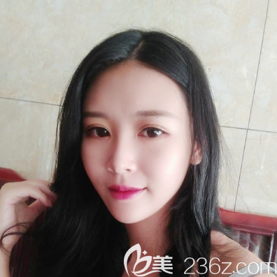 鄒順祿醫(yī)生全臉自體脂肪填充案例術后15天效果 鄒順祿醫(yī)生全臉自體脂肪填充案例術后15天效果