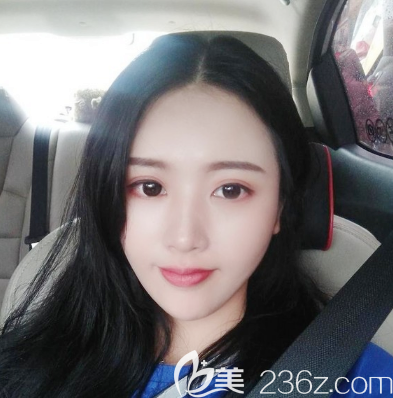 廣州荔醫(yī)鄒順祿做的脂肪填充效果怎么樣 廣州荔醫(yī)鄒順祿做的脂肪填充效果怎么樣