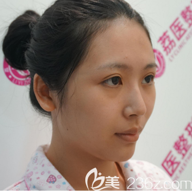 在廣州荔醫(yī)做脂肪填充前的樣子 在廣州荔醫(yī)做脂肪填充前的樣子