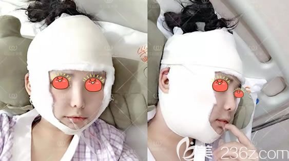 剛做完長曲線下頜角切除術圖片 剛做完長曲線下頜角切除術圖片