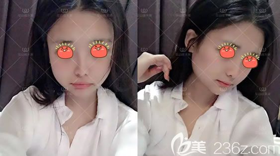 杭州連天美長曲線下頜角案例 杭州連天美長曲線下頜角案例