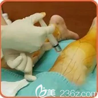 嘉興禾美注射瘦腿過程 嘉興禾美注射瘦腿過程