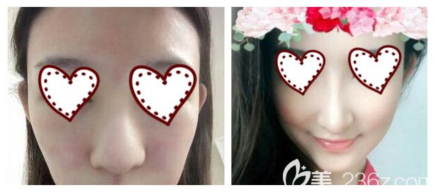 南寧東方整形趙波院長(zhǎng)鼻整形失敗修復(fù)案例