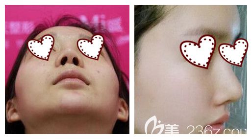 南寧東方整形假體隆鼻失敗修復(fù)案例