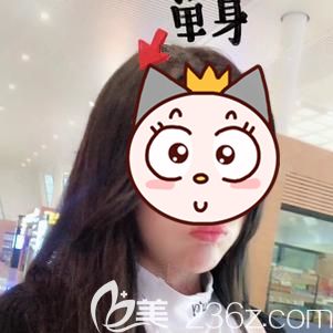 用黑金潤百顏玻尿酸墊下巴一個多月，讓大家看看我在武漢壹加壹做的怎么樣