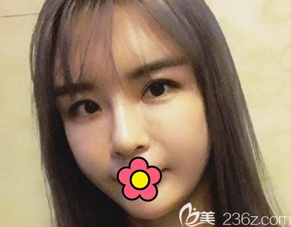 蘭州仁和<!--<i data=20240703-sp></i>-->全臉脂肪填充第5天照片 蘭州仁和<!--<i data=20240703-sp></i>-->全臉脂肪填充第5天照片