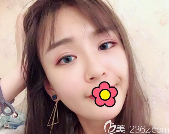 蘭州仁和全臉脂肪填充40天效果 蘭州仁和全臉脂肪填充40天效果