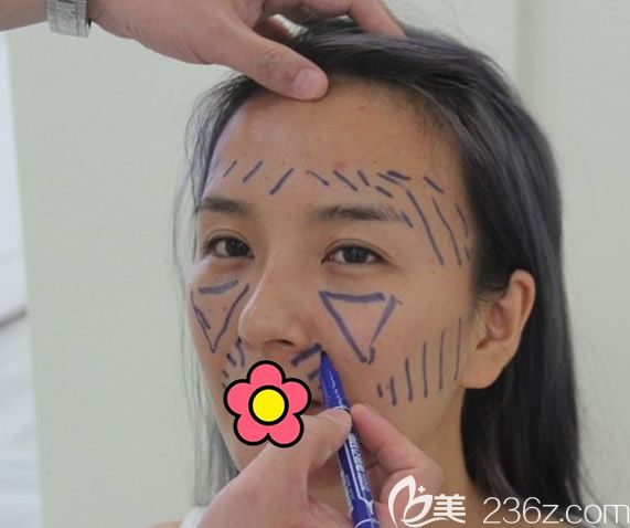 蘭州仁和醫(yī)院自體脂肪面部填充前 蘭州仁和醫(yī)院自體脂肪面部填充前