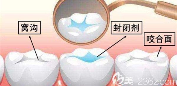 窩溝封閉操作流程