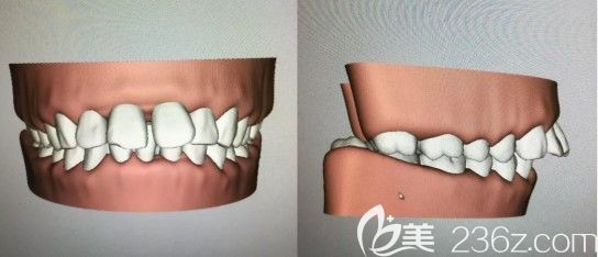 在湛江致美口腔醫(yī)院做齙牙矯正前的牙齒情況 在湛江致美口腔醫(yī)院做齙牙矯正前的牙齒情況